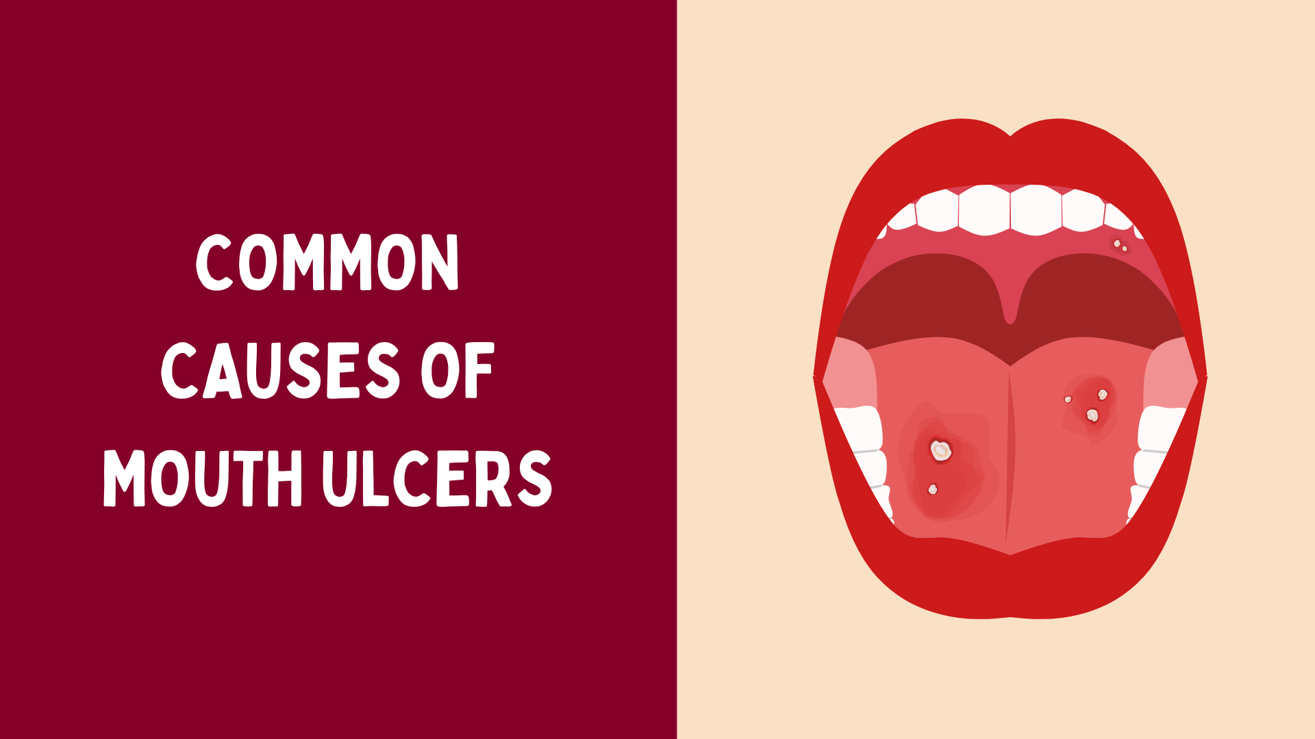 Mouth Ulcers